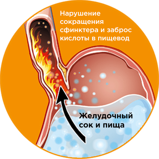 Изжога - причины и методы борьбы с неприятным симптомом